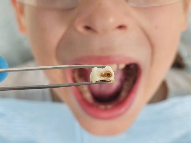Best Emergency Treatment for Oral Infections in Providence Village, TX